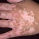 Penyakit Kulit Vitiligo, Penyebab Dan Cara Mengobatinya