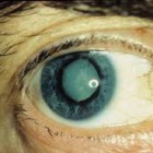 Penyakit Mata Katarak, Penyebab, Tanda Ciri Gejala, Pencegahan, Dan Cara Mengobatinya