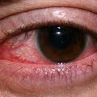 Penyakit Mata Merah, Penyebab, Tanda Ciri Gejala, Pencegahan, Dan Cara Mengobatinya