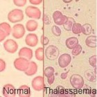 Penyakit thalasemia dan penyebabnya