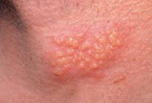 Penyakit Kulit Herpes, Penyebab, Dan Cara Mengobatinya