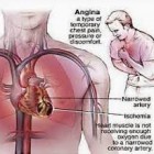 Penyakit Jantung Koroner, Patofisiologi, Penyebab, Gejala dan Pengobatannya