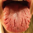 Penyakit pada lidah, pencegahannya , ciri ciri gejalanya , dan pengobatanya