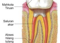 Penyakit gigi , mulut dan gusi , pencegahannya , ciri ciri gejalanya, dan pengobatanya