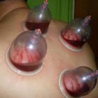Manfaat Bekam bagi Kesehatan